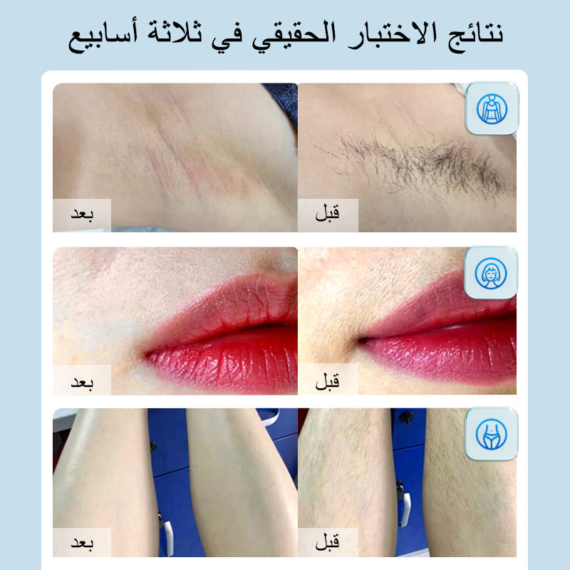 جهاز الليزر المنزلي لإزالة الشعر باللون الأزرق الياقوتي ملاي T14 (5*العدسات)+هدية مجانية:تنظيف البشره بالفقاعات